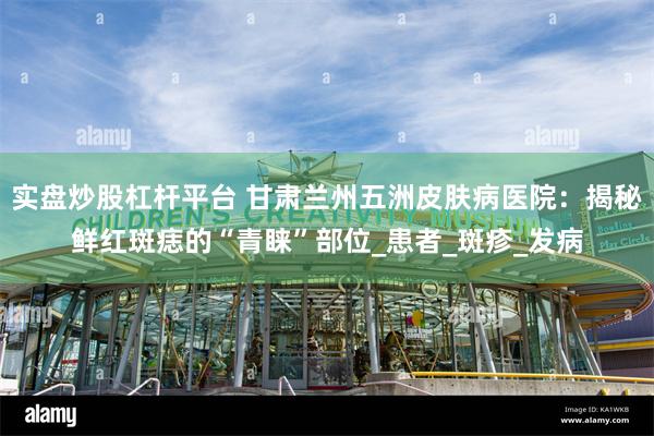 实盘炒股杠杆平台 甘肃兰州五洲皮肤病医院：揭秘鲜红斑痣的“青睐”部位_患者_斑疹_发病